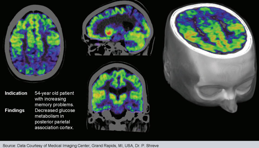PET-CT Delivers Earlier, More Accurate of Alzheimer's Disease | Northwest Radiology | Indianapolis | Carmel | Greenwood | Avon